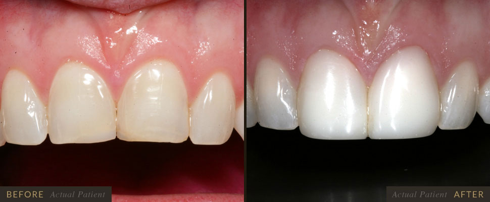 Dental bonding will close spaces between teeth.