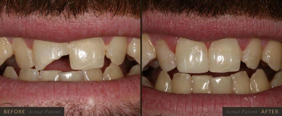 Dental bonding will make teeth longer and improve the shape of your teeth.